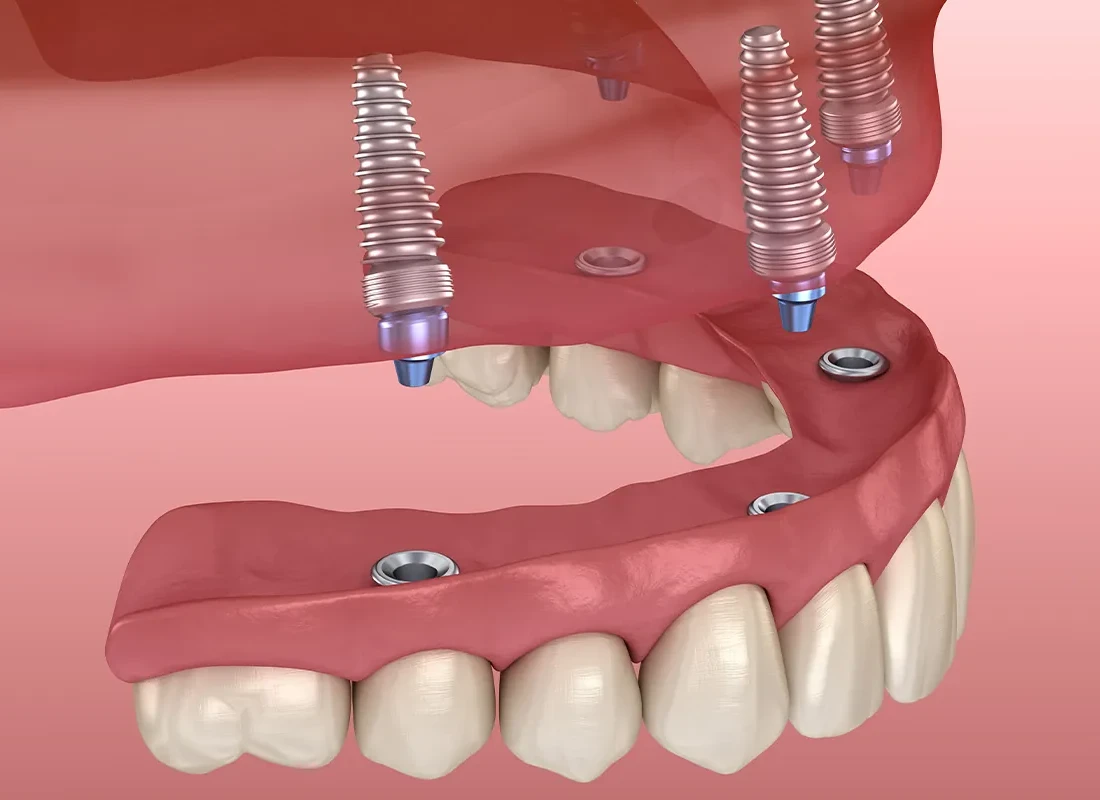 What is All-on-4 Dental Implants