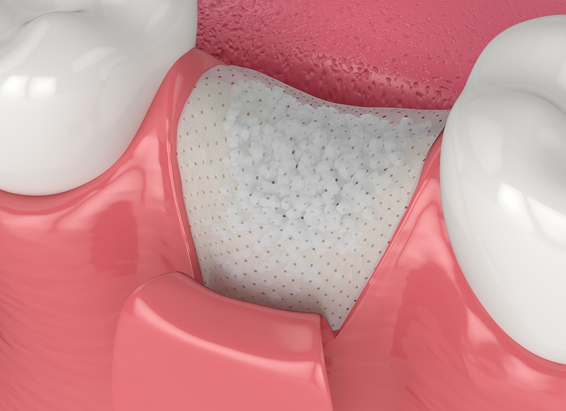 What is Bone Grafting