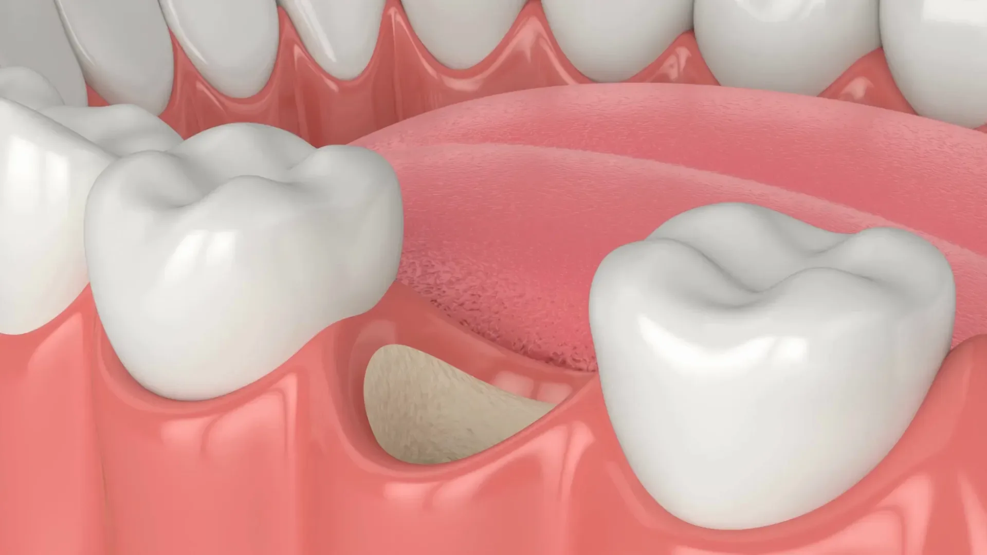 Bone Grafting in Fullerton, CA