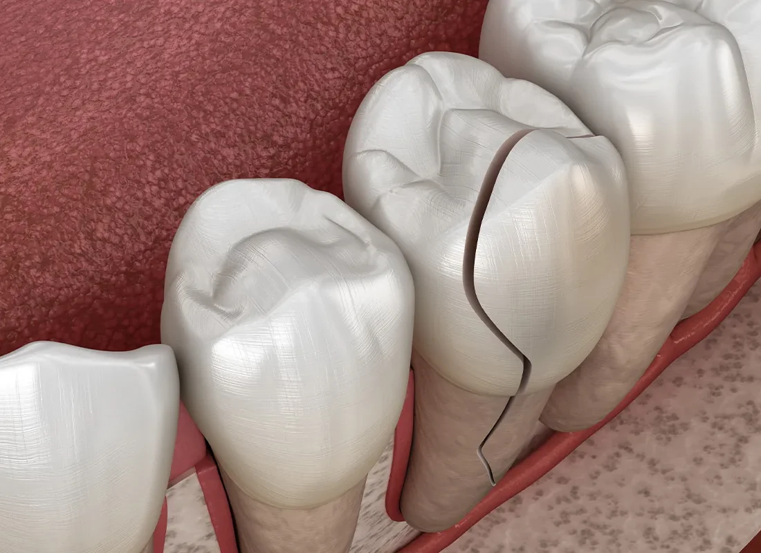 How a Small Crack in Your Tooth Can Quietly Turn Into a Much Bigger Problem