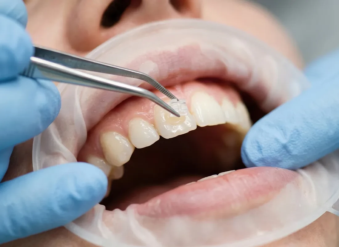 Cosmetic Bonding in Fullerton, CA