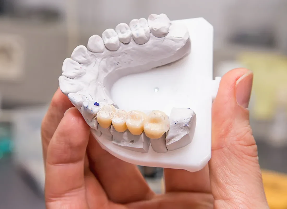 Dental Bridges in Fullerton, CA