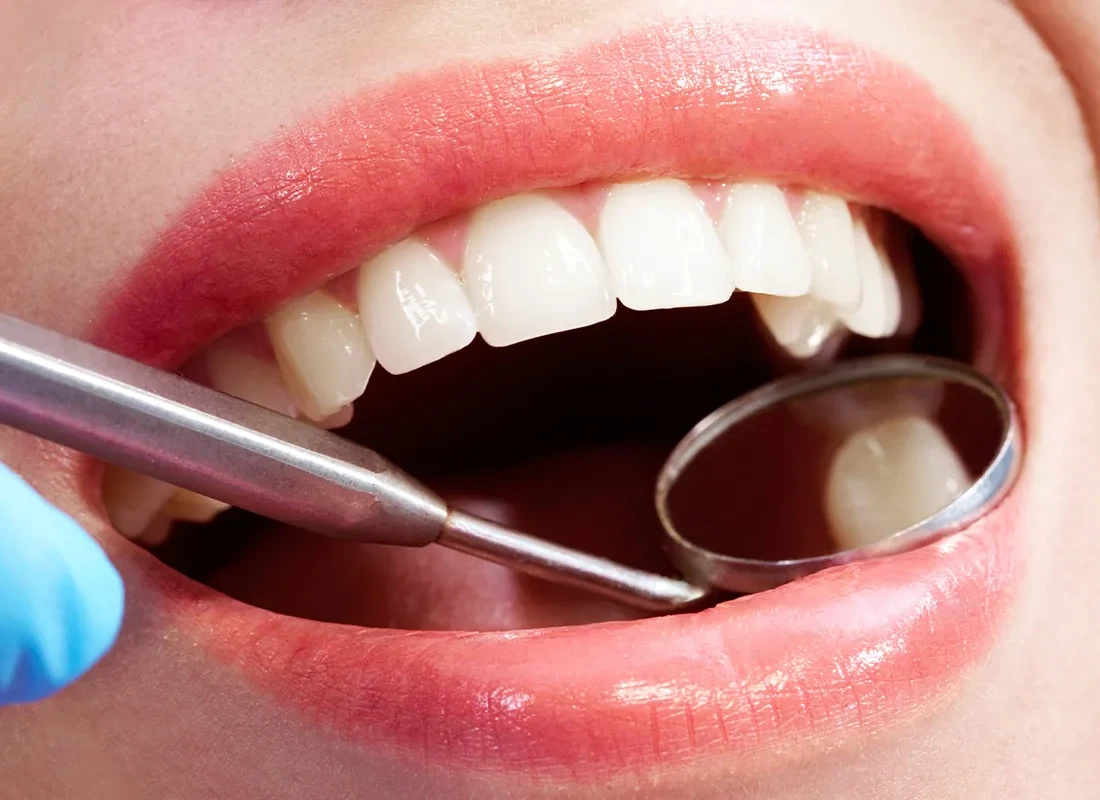 What is Oral Cancer Screening
