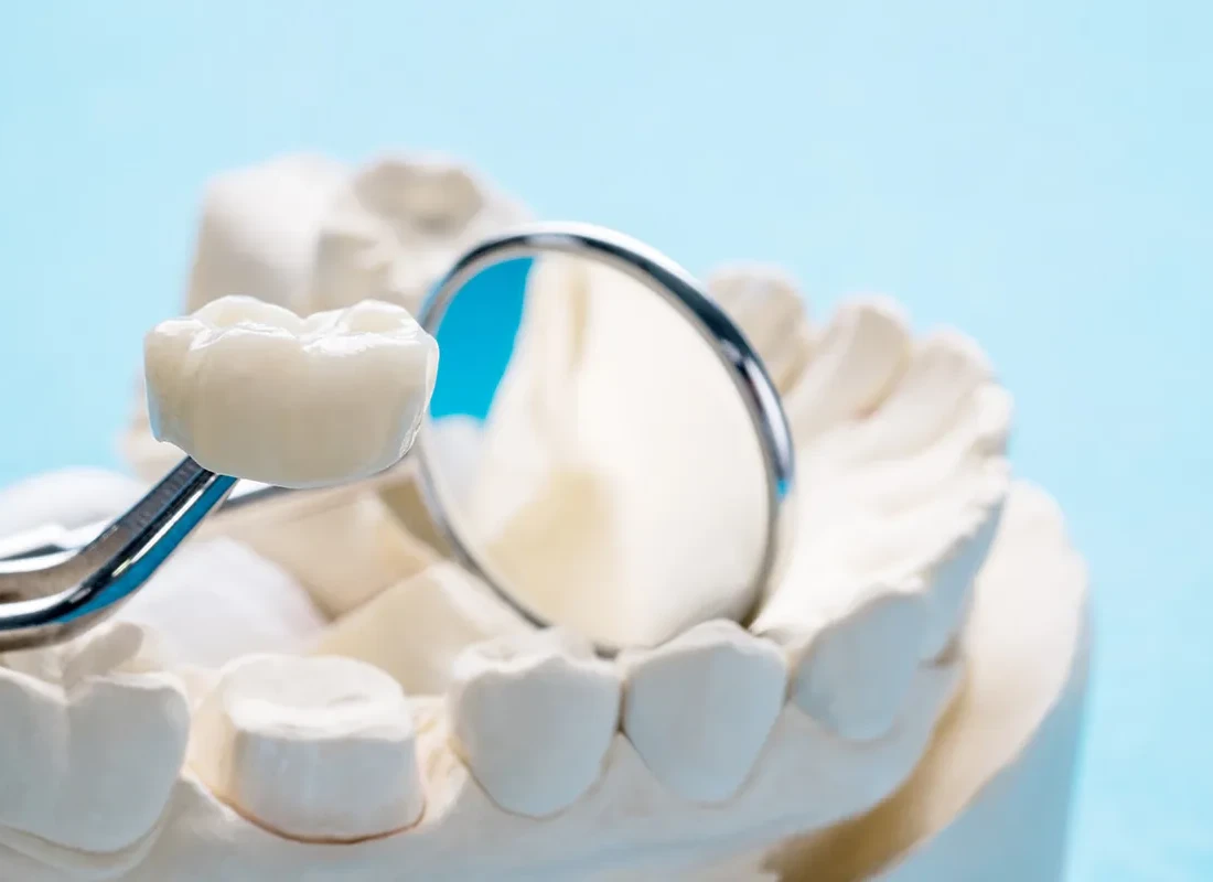 What is Dental Crowns