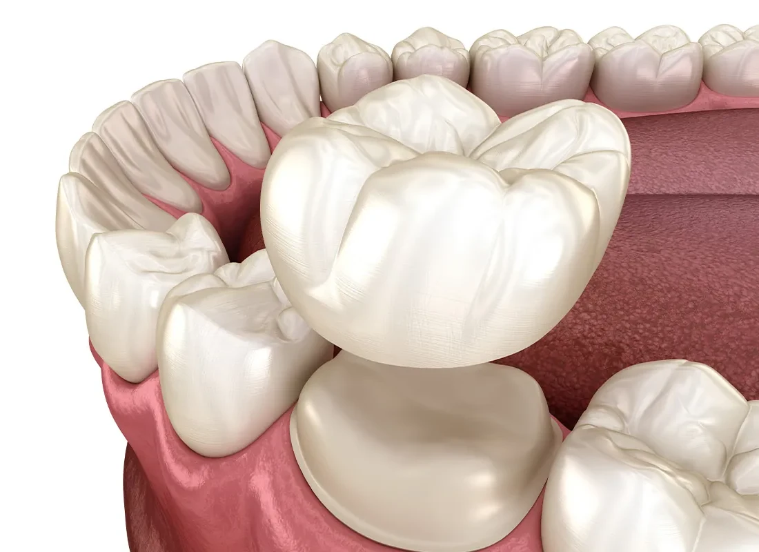 When Does a Tooth Actually Need a Crown?