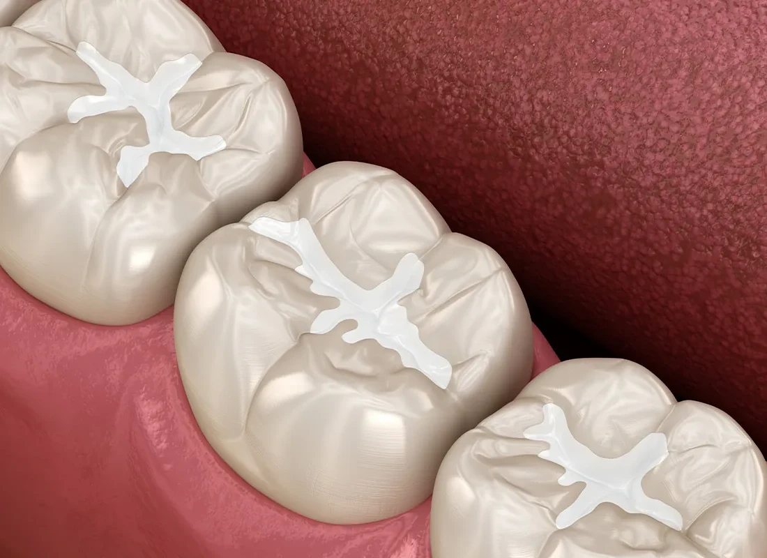 Inlays and Onlays vs. Fillings: Which One Is Stronger?