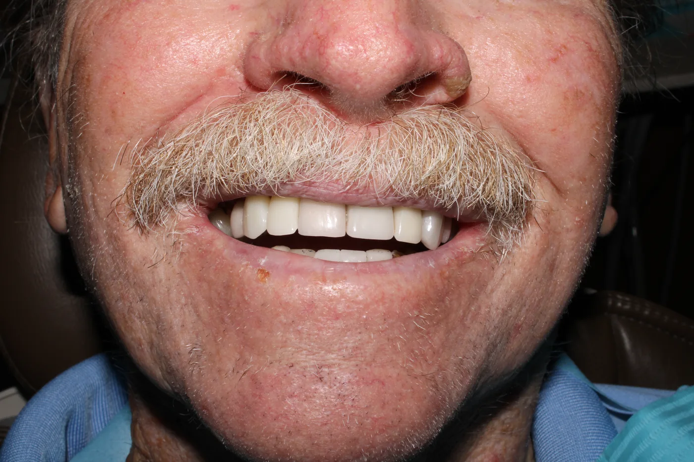 After — Dental implant