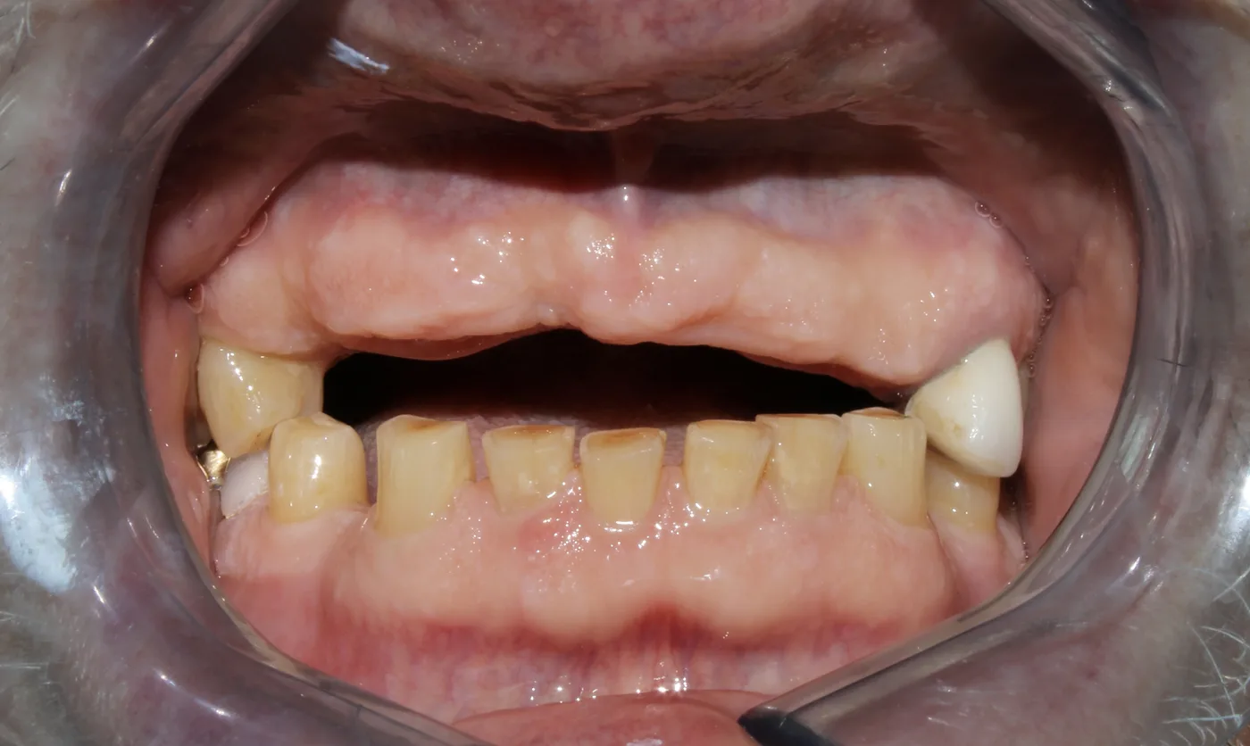 Before — Dental implant