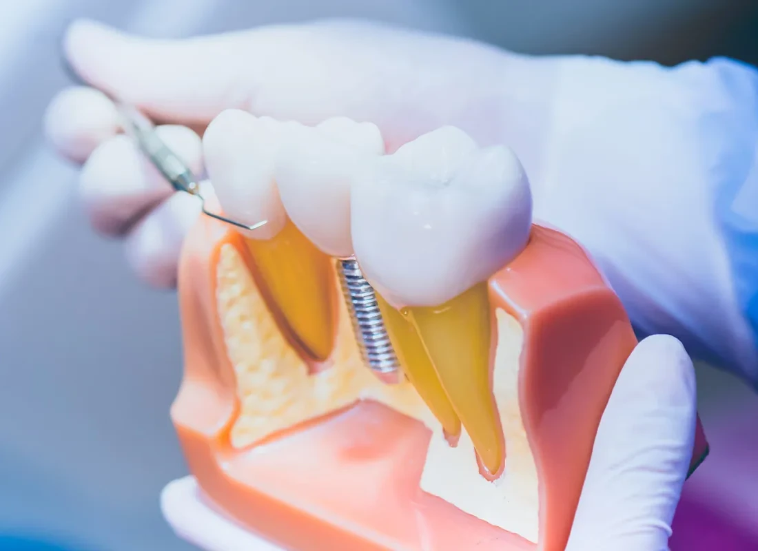 Dental Implants vs. Dentures: Which Option Is Worth the Investment Long Term?