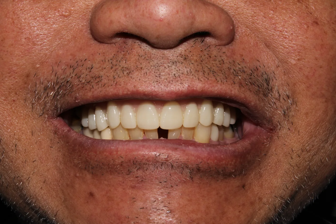 After — Dentures