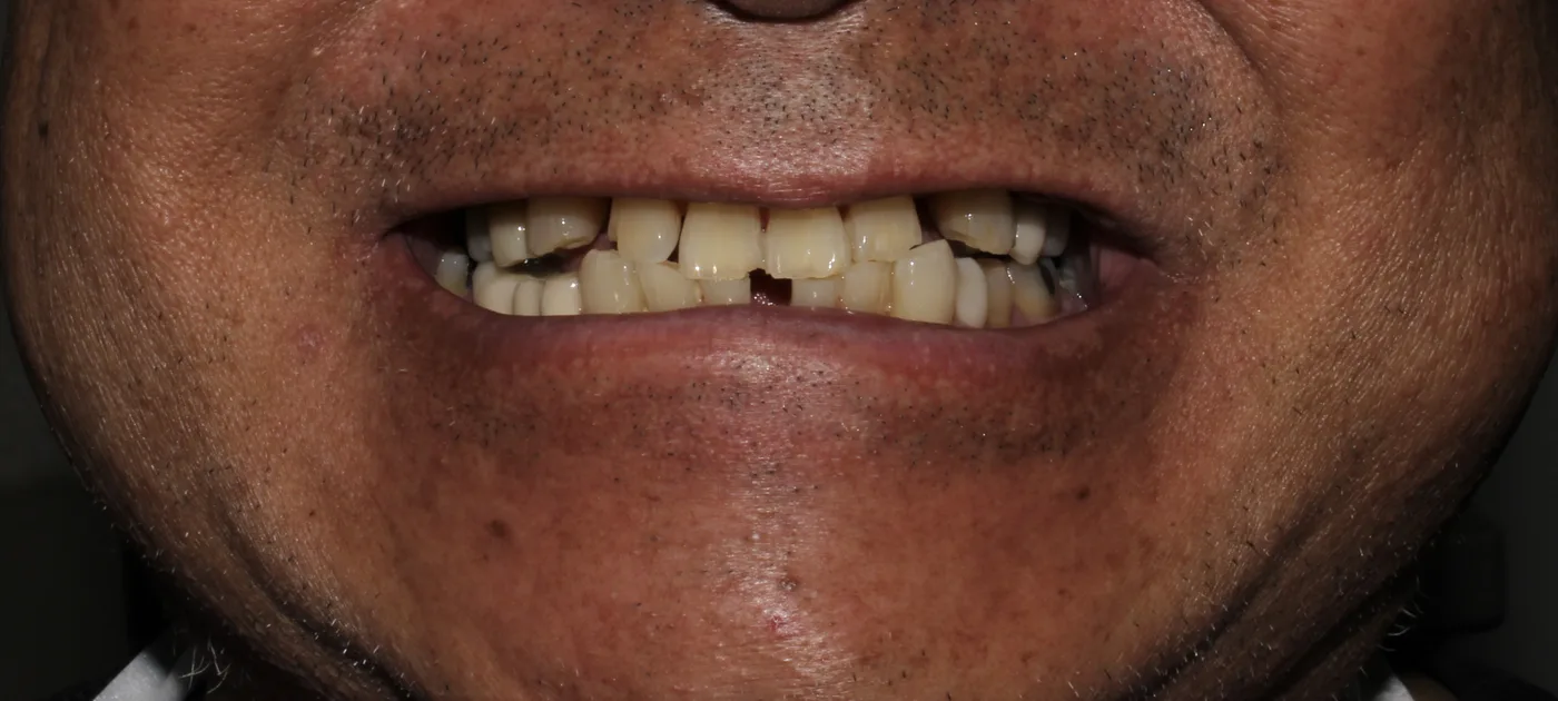 Before — Dentures