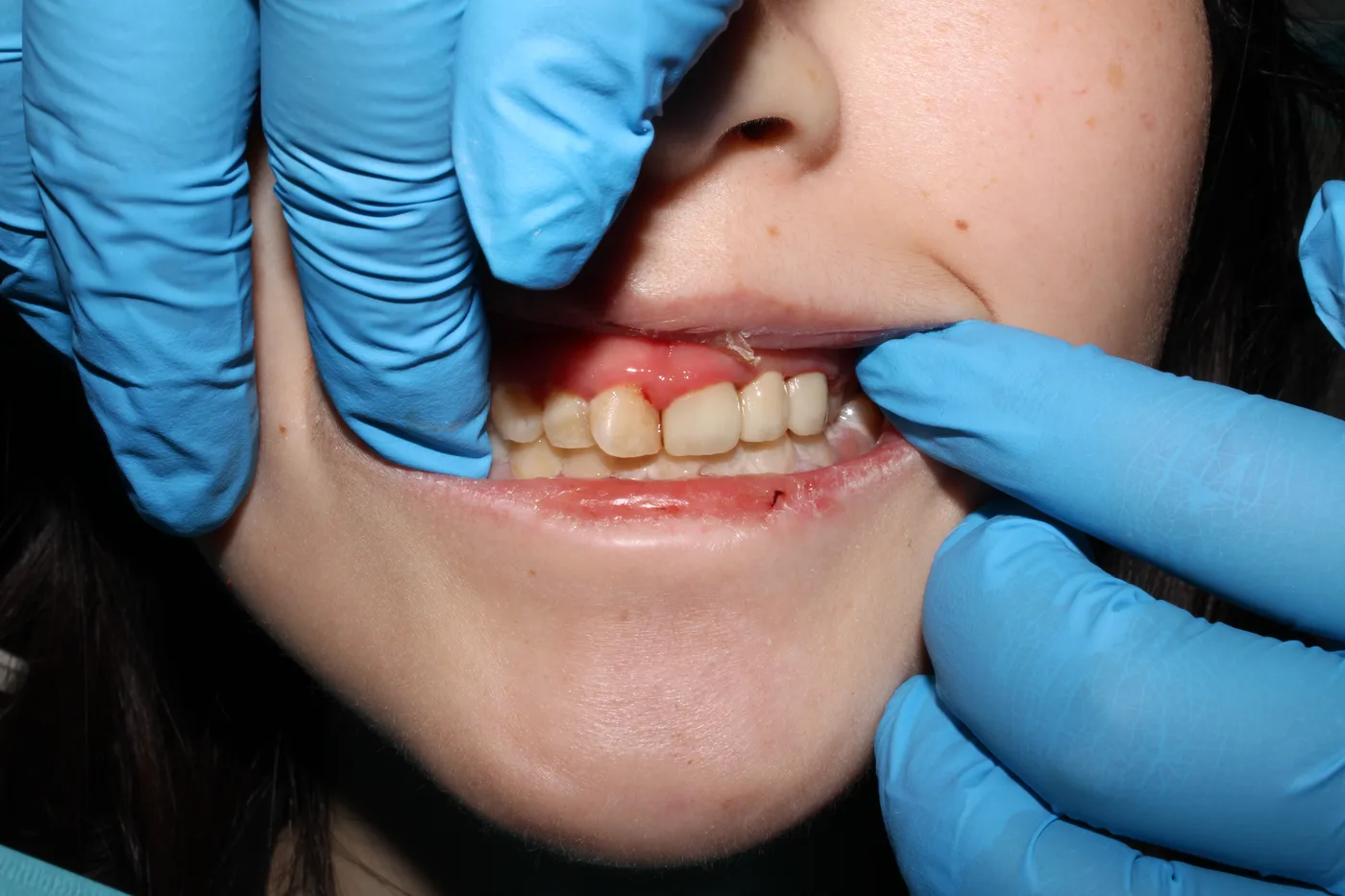After — Front teeth restoration