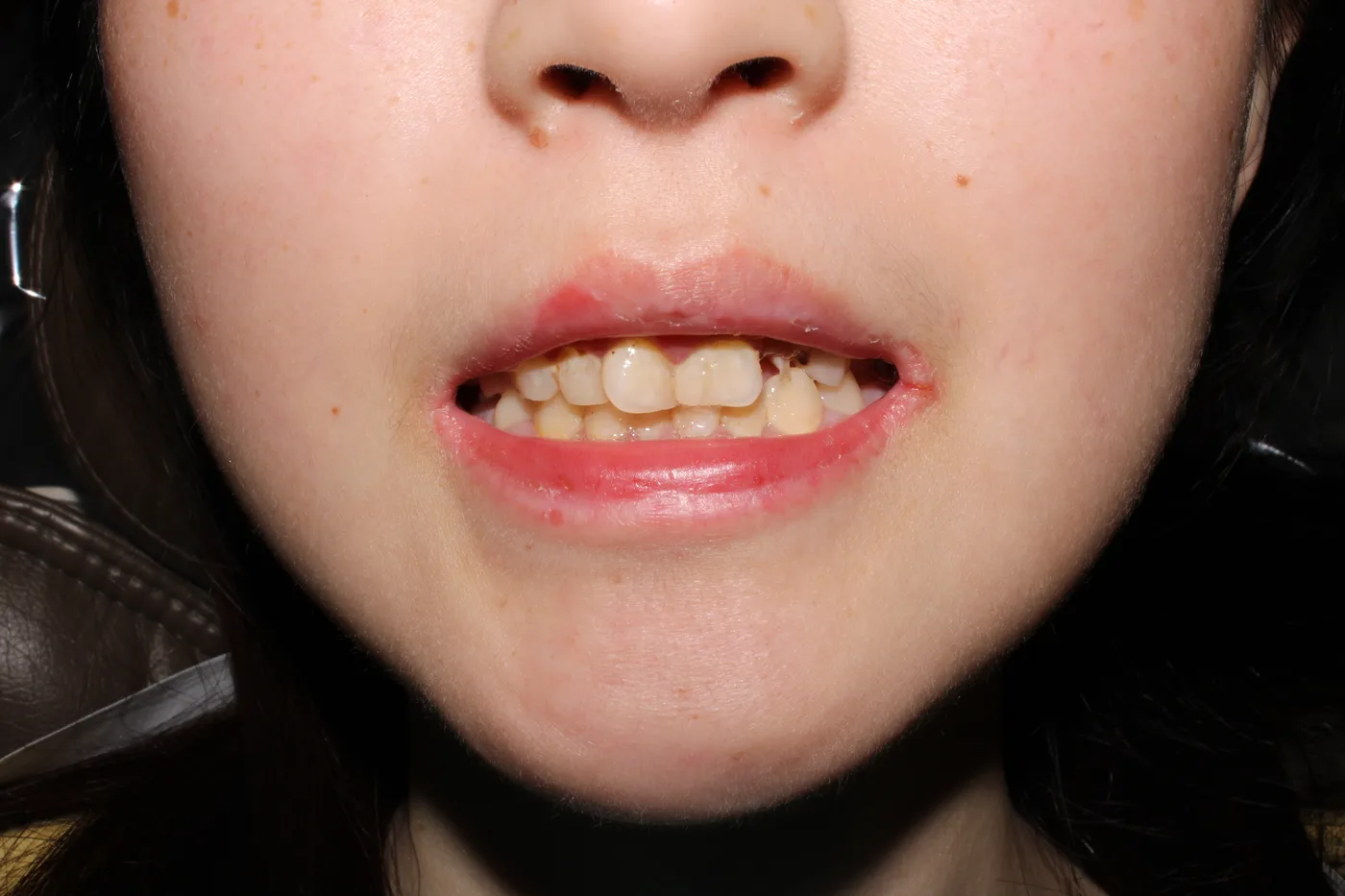 Before — Front teeth restoration