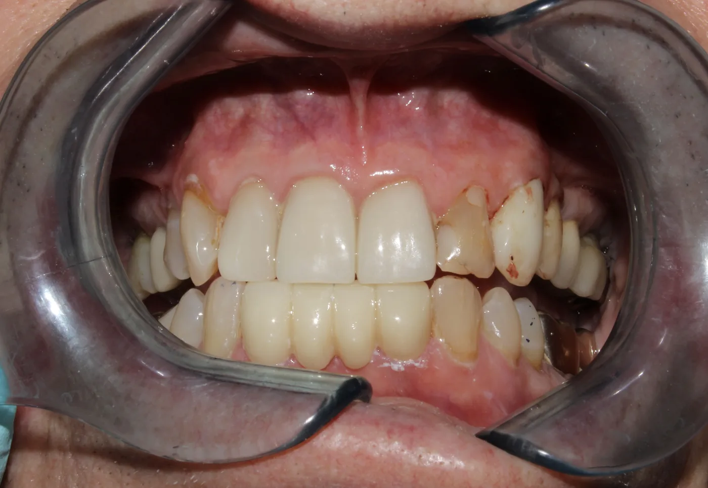 After — Front teeth restoration