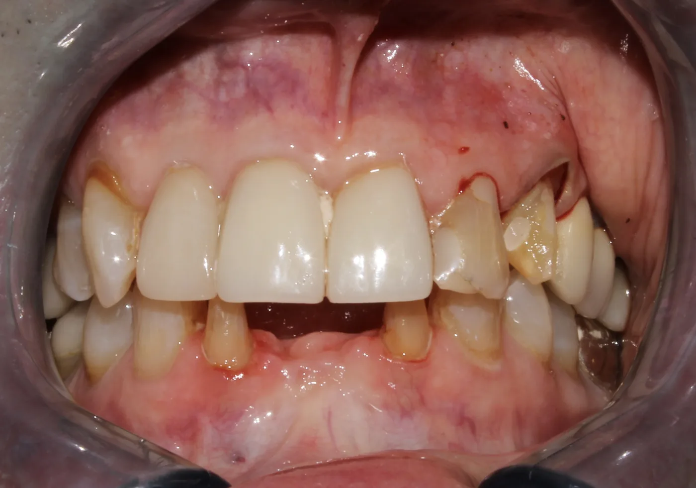 Before — Front teeth restoration
