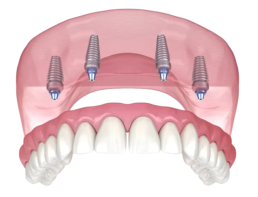 All-on-4 Dental Implants in Fullerton, CA