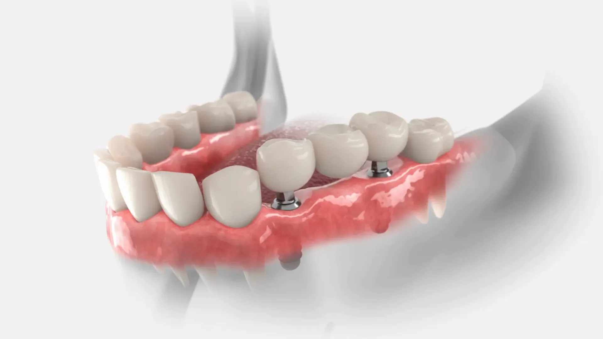 What is Implant-Supported Bridges