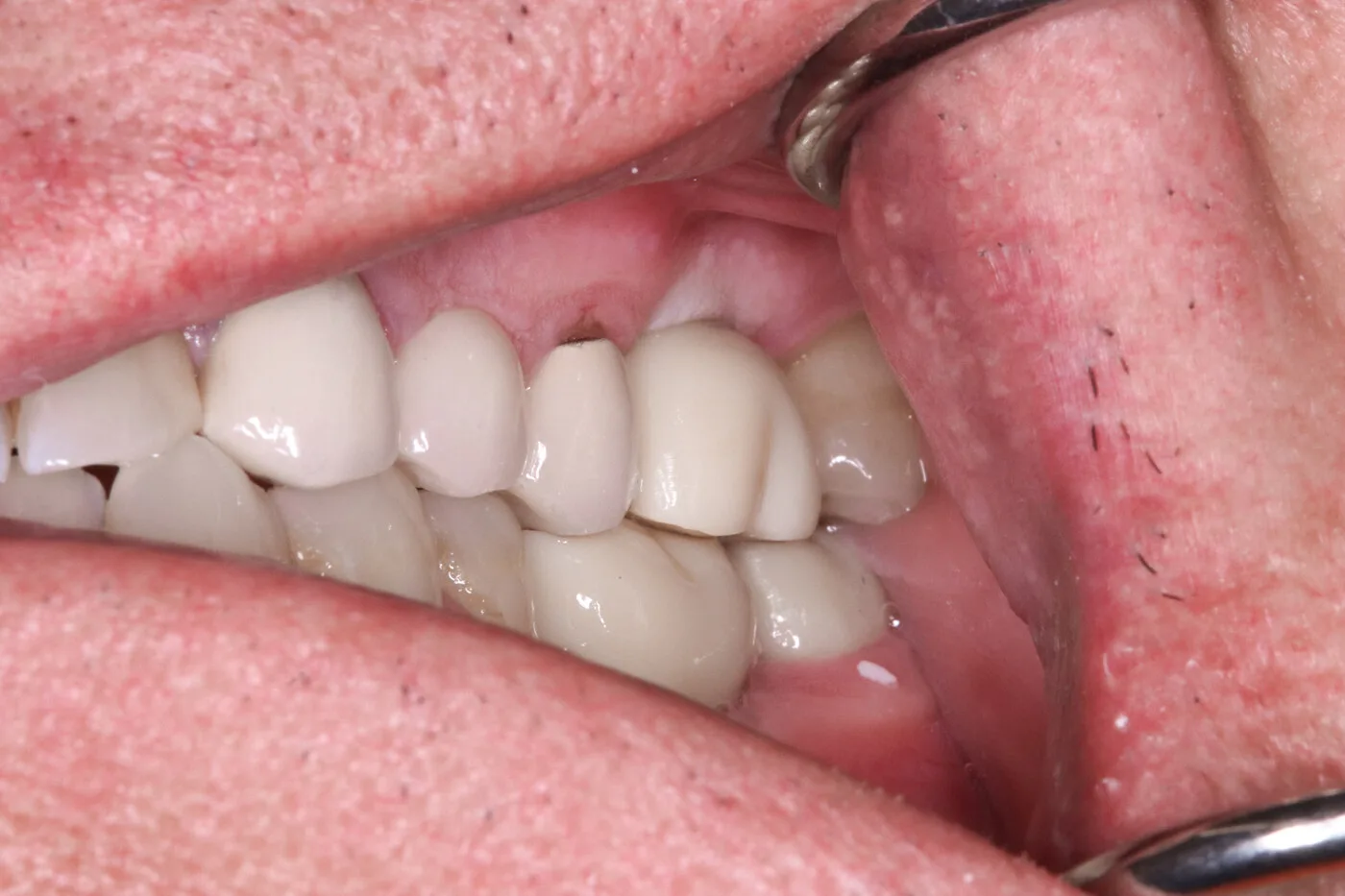 After — Implant crowns & bridge