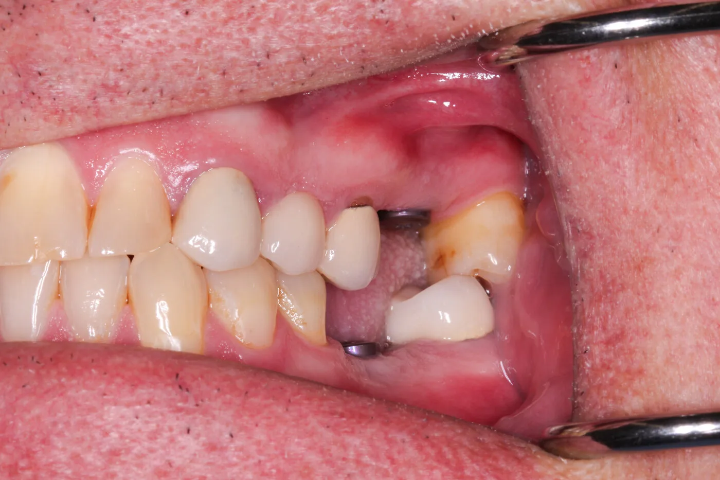 Before — Implant crowns & bridge
