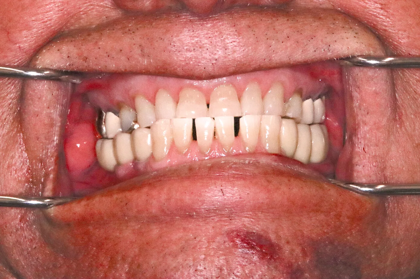 After — Implant crowns & bridge