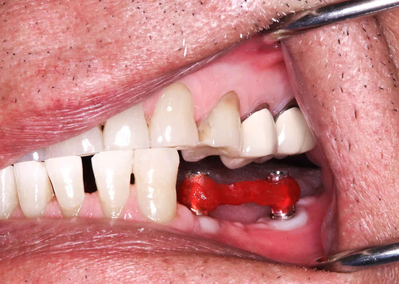 Before — Implant crowns & bridge