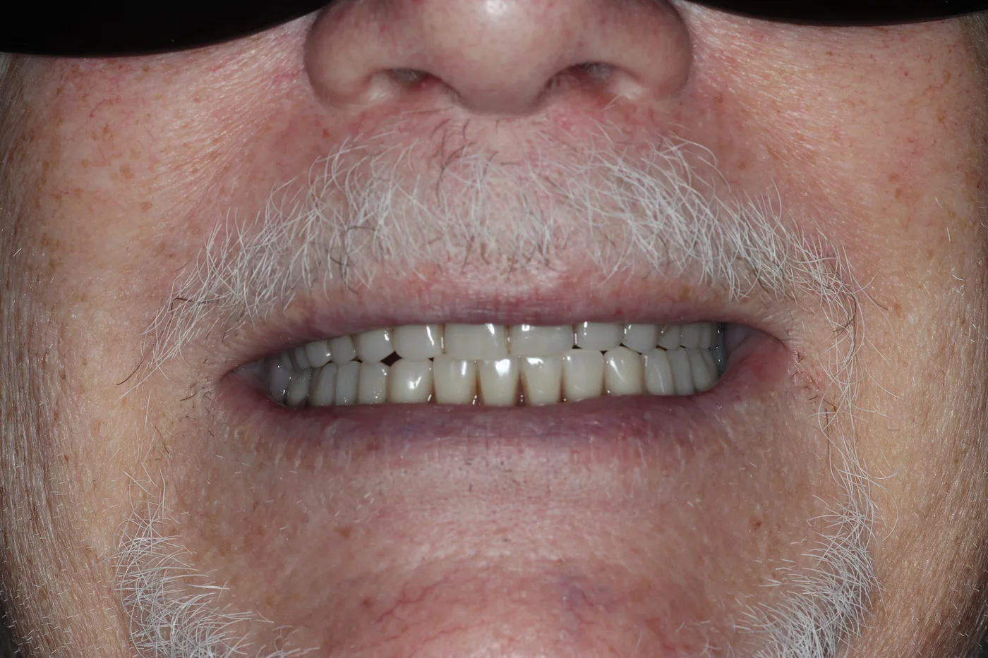 After — Implant overdenture