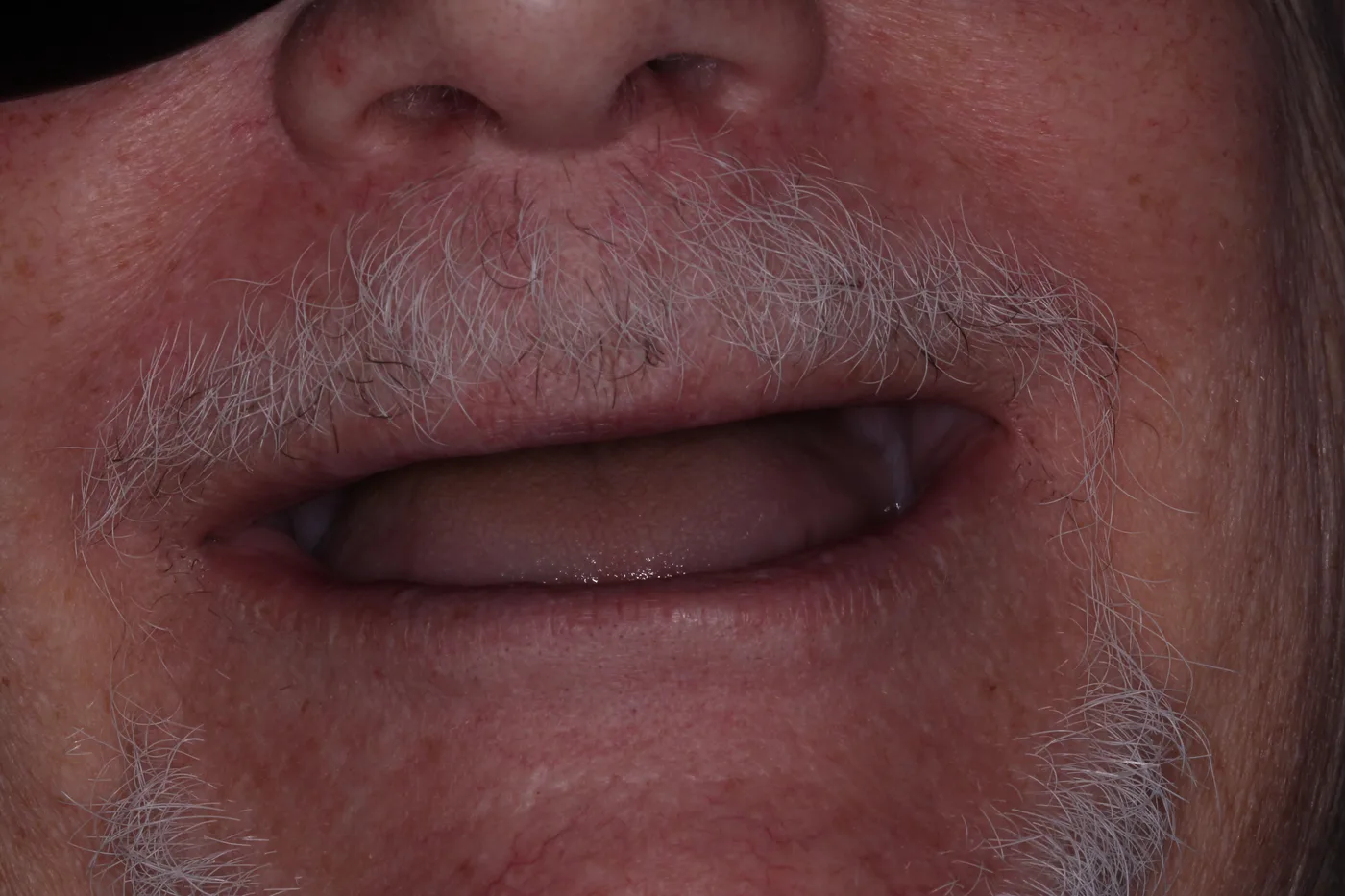 Before — Implant overdenture