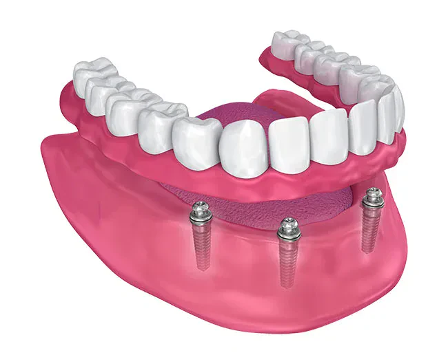 Implant-Supported Dentures/Overdentures
