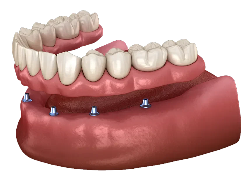Implant-Supported Dentures in Fullerton, CA