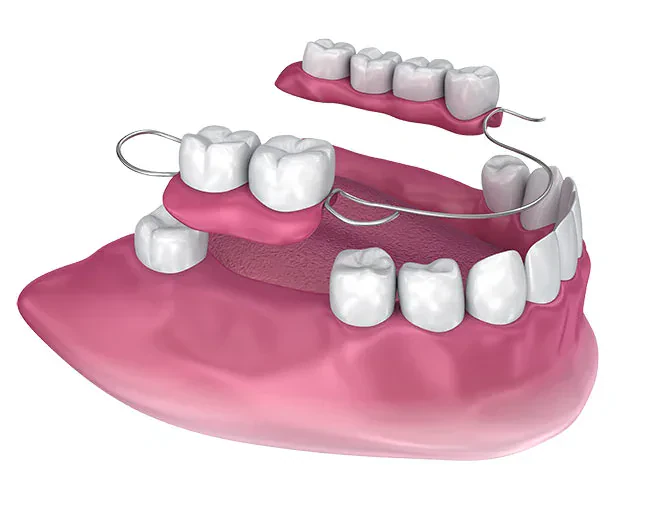 Partial Dentures