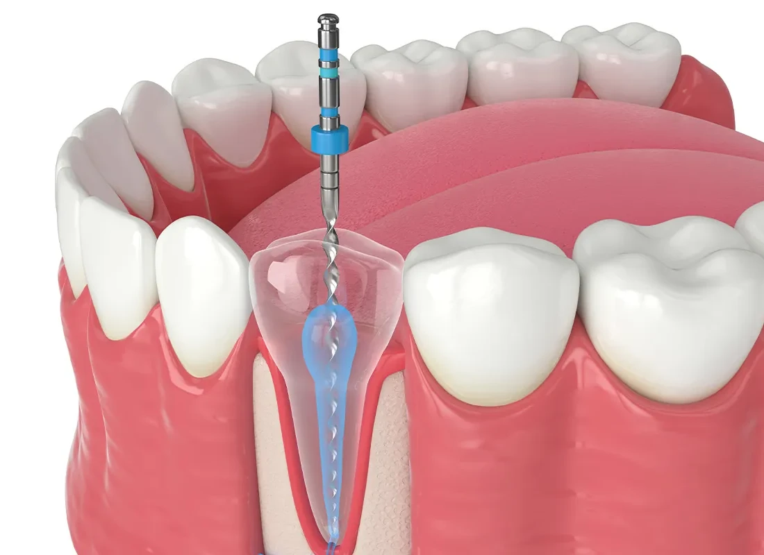 What is Root Canals