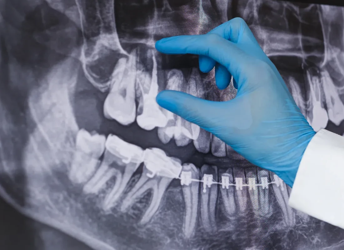 Root Canals in Fullerton, CA