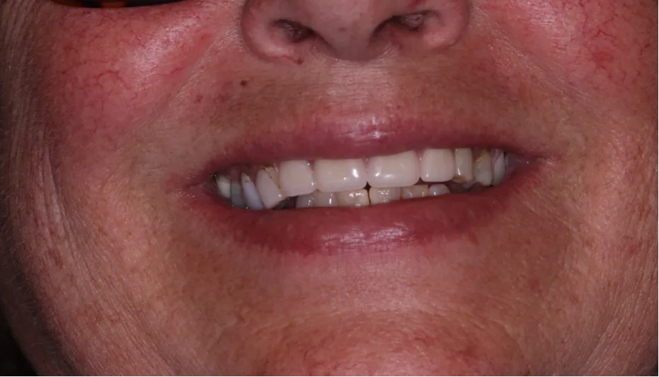 After — Smile makeover