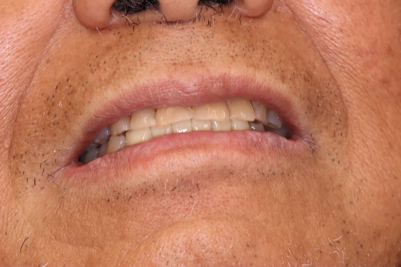 After — Smile makeover