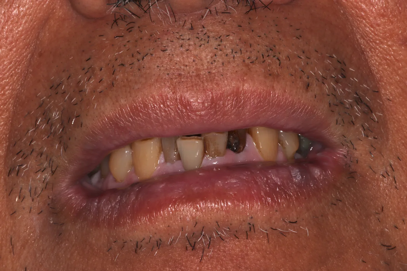 Before — Smile makeover