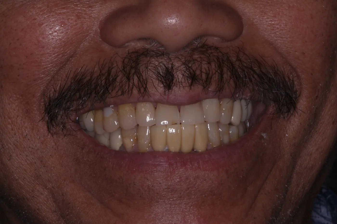 After — Smile makeover