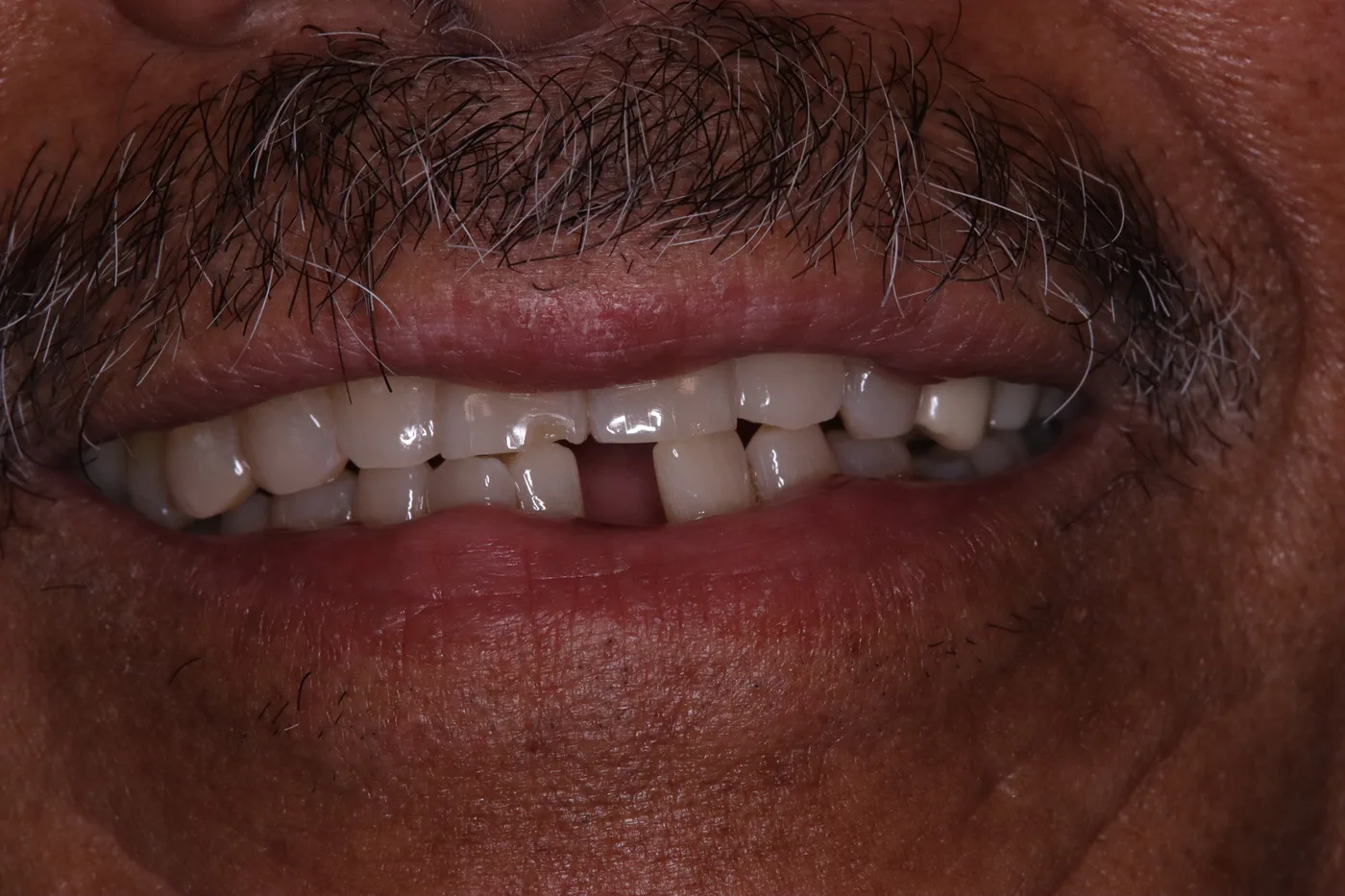 Before — Smile makeover