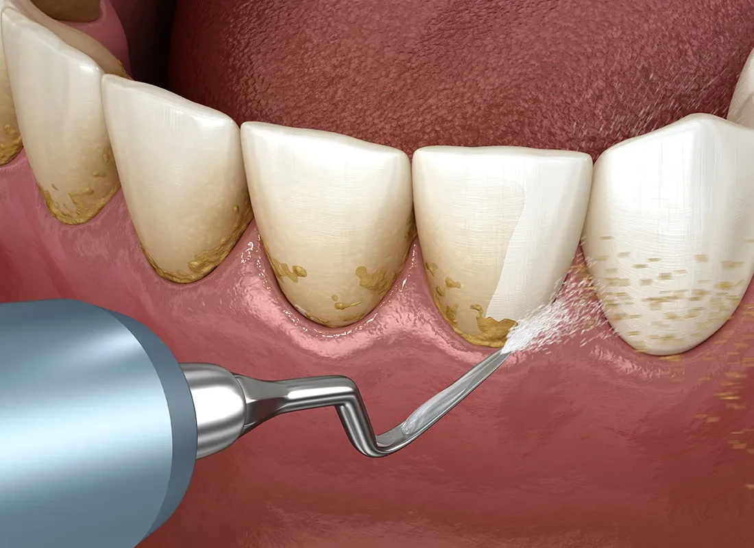 Is It Enough to Have a Dental Cleaning Twice a Year?