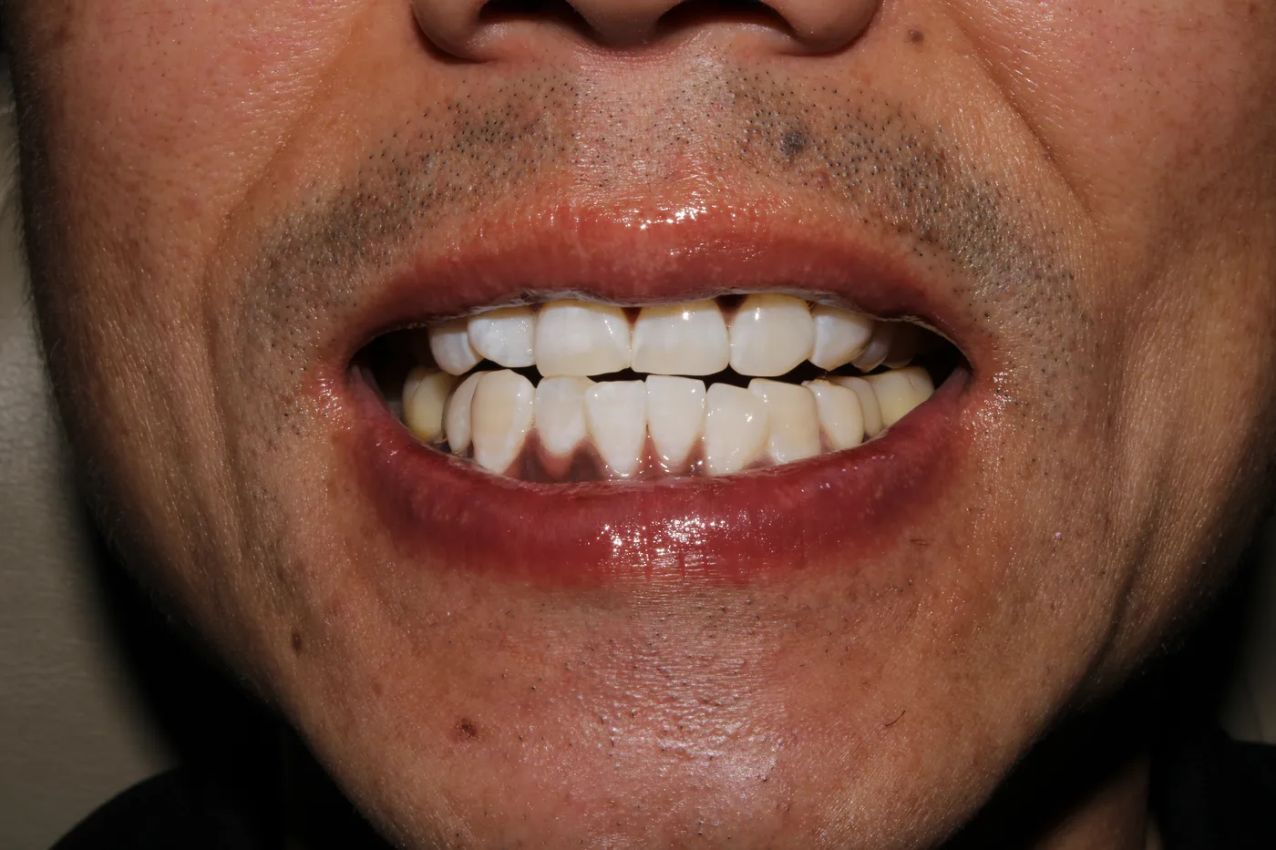 After — Teeth whitening