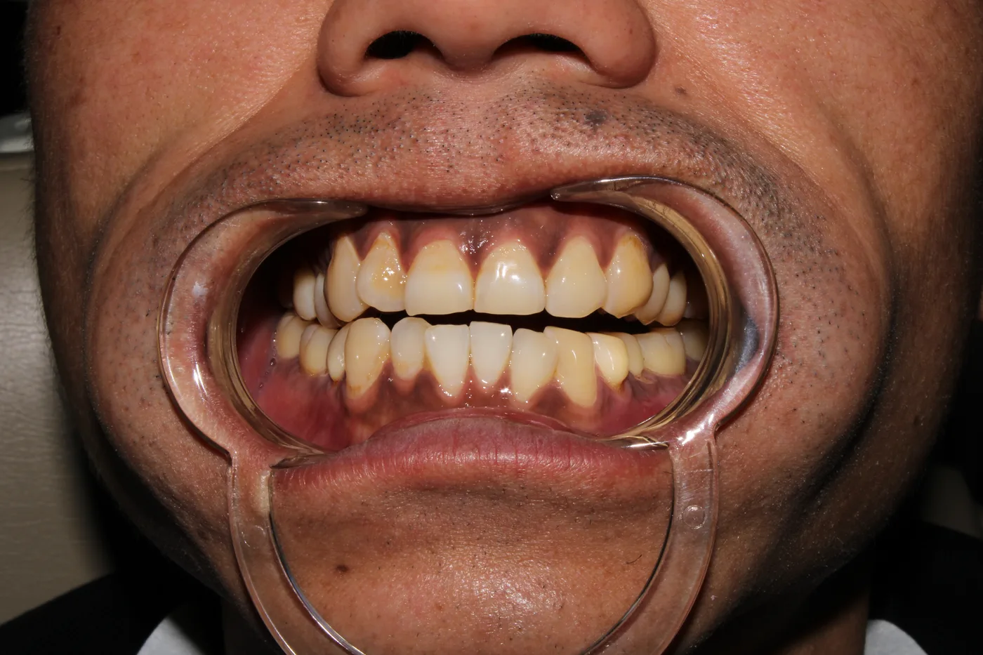 Before — Teeth whitening