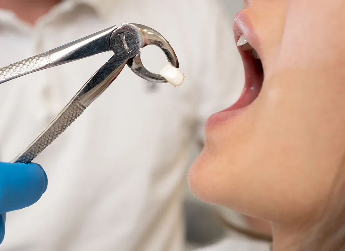 Tooth Extraction in Fullerton, CA