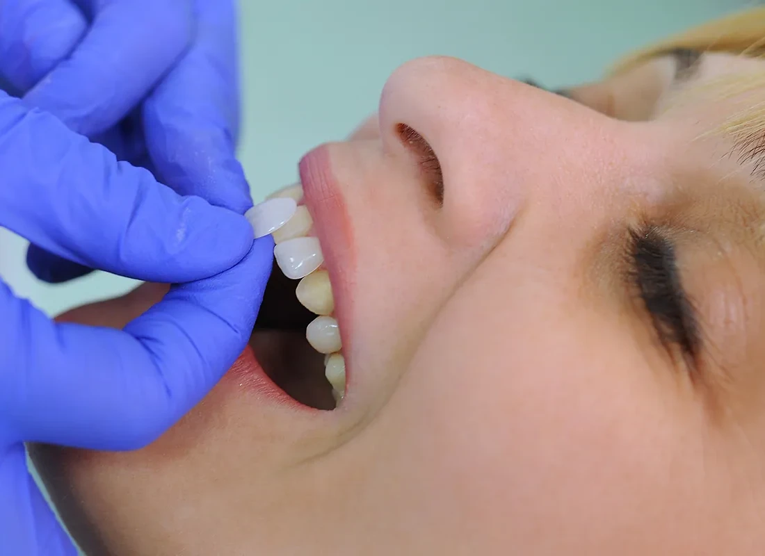I Want Veneers - What Should I Expect During the Consultation?