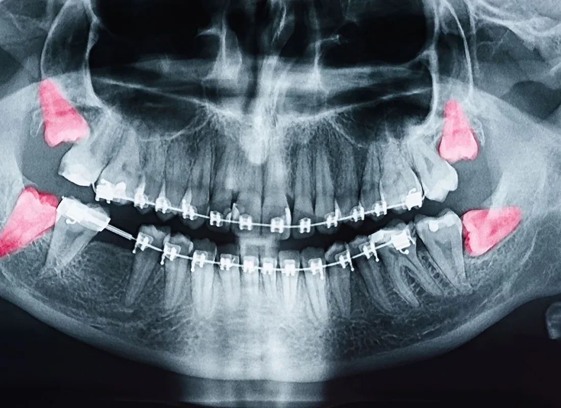 Is It True That I'll Get Dry Socket After Wisdom Teeth Removal?